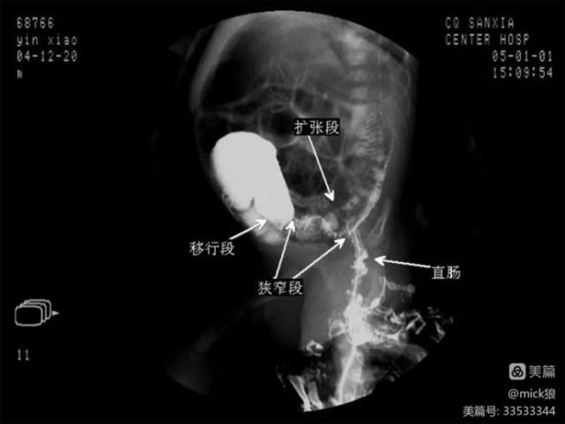 女子家中自行灌肠导致水中毒，健康行为的警示与误区